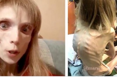 Mając 26 lat waży jedynie 17 kg. Jej dieta to kawałek banana i woda, bo nie może przełknąć nic więcej 