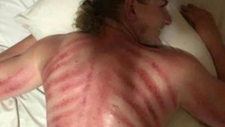 Zamówił masażystę do pokoju podczas egzotycznych wakacji! Obudził się z czerwonymi pręgami na całych plecach