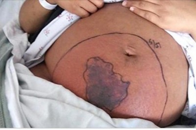 Ciężarna obudziła się z okropny bólem brzucha. Gdy spojrzała w dół, zauważyła, że chodzi po niej pająk