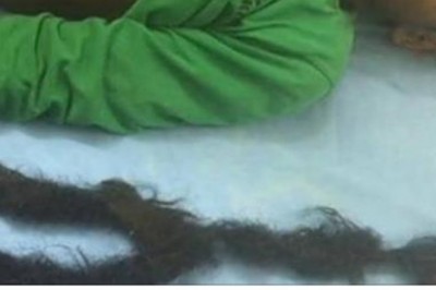 Miał ostre bóle brzucha i w końcu musiał być operowany. Po 3 godzinach wyciągnęli z niego żerującego brata bliźniaka