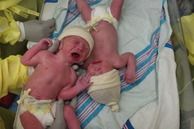 Po urodzeniu te bliźniaki nie przestawały płakać. Wystarczył jeden gest położnej by je uspokoić