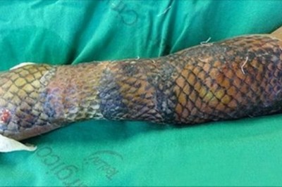 Jej ręce i nogi były pokryte rybią łuską przez 3 tygodnie. Kiedy lekarze ją ściągają są zaskoczeni rezultatem