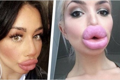 25 kobiet które zdecydowanie przesadziły powiększając sobie usta. Dlaczego nikt im nie powiedział stop