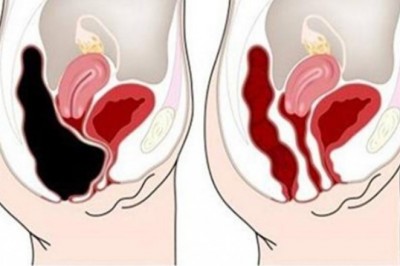 Stosują te dwa naturalne preparaty usunęła 9 kg nieczystości zalegających w organizmie. Zobacz jaka zmiana
