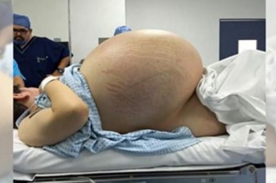 Wyglądała jak w ciąży z 5-raczkami. Jak lekarze prześwietlili jej brzuch nie mogli uwierzyć co znaleźli