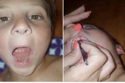 Syn skarżył się na bóle dziąseł. W jego ustach mama znalazła wrośnięte 32 paznokcie