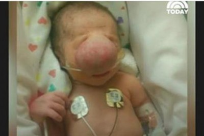 Lekarze usunęli wielką narośl z twarzy maluszka. Widok jego buzi po zabiegu wzruszył wszystkich