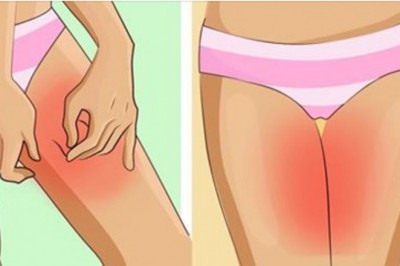 Dzięki tym 7 trikom zapomnisz o obtarciach na udach w upalne dni. Nogi Ci podziękują