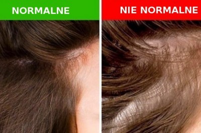 5 rzeczy, które twoje włosy mogą zdradzić na temat twojego zdrowia. Zobacz które objawy są niepokojące
