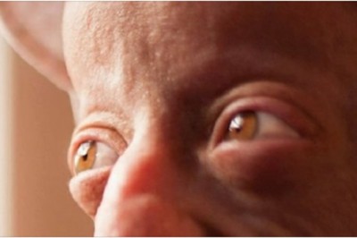 Ma tylko 20 lat, a ciało jak 140-latka. Wszystko przez rzadką chorobę 