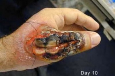 Boisz się pająków to nie oglądaj. Tak wyglądają ślady po ugryzieniach tych najgroźniejszych