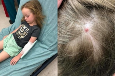 Zdrowa 5-latka nagle doznaje całkowitego paraliżu ciała. Przyczynę znaleziono we włosach 