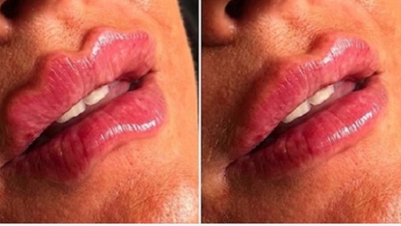 Octopus Lips to nowa moda na powiększanie ust. Coraz popularniejsza na Instagramie