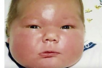 Kiedy się urodził ważył 7,5 kg. Teraz ma 35 lat i bardzo wyróżnia się na tle innych ludzi