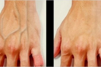 Dlaczego u niektórych ludzi żyły są mocno widoczne pod skórą? Zobacz co to może oznaczać