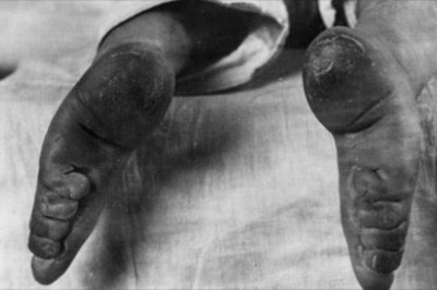 7 absurdalnych trendów mody z przeszłości. Kobiety dla piękna poświęcały wiele