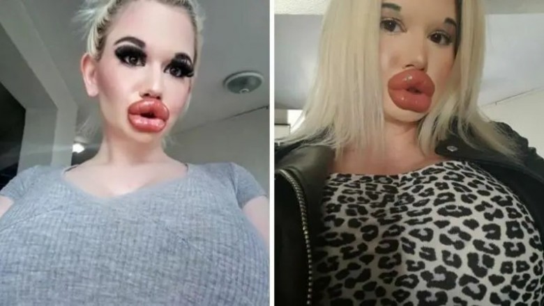 Chce wyglądać jak „żywa Barbie”. Ta 23-latka ma największe usta na świecie
