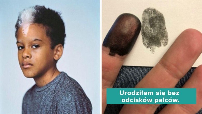 18 zdjęć osób których geny wyposażyły w unikalne cechach wyglądu