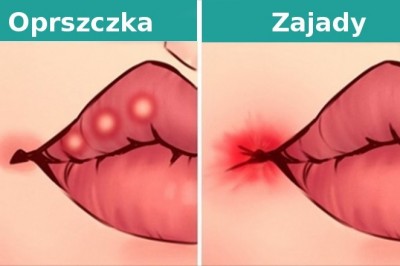 8 rzeczy, jakie stan twoich ust może powiedzieć o stanie twojego zdrowia