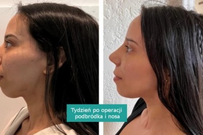 15 osób, które postawiły na operację plastyczną i trafiły w dziesiątkę